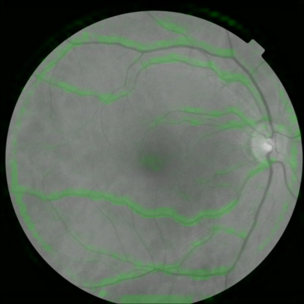 Using AI to predict cardio events from retina scans